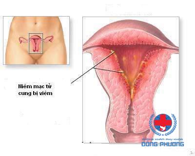 Nguyên nhân viêm nội mạc tử cung