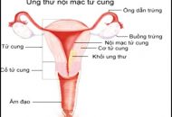 Biểu hiện của bệnh viêm nội mạc tử cung ở phụ nữ
