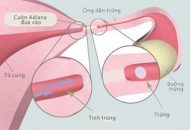 biểu hiện viêm ống dẫn trứng
