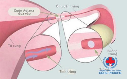 biểu hiện viêm ống dẫn trứng