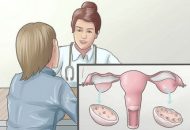 Cách điều trị viêm buồng trứng mãn tính