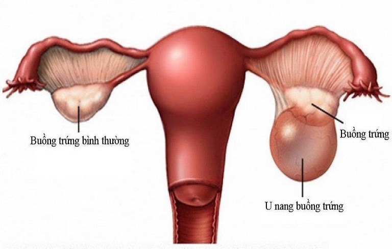 Đau bụng kinh cũng có thể là dấu hiệu u nang buồng trứng.