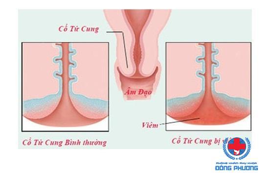 Cách điều trị viêm cổ tử cung là gì?