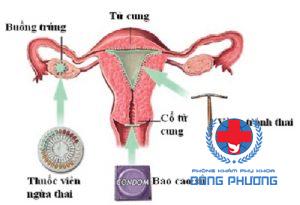 có mấy loại vòng tránh thai