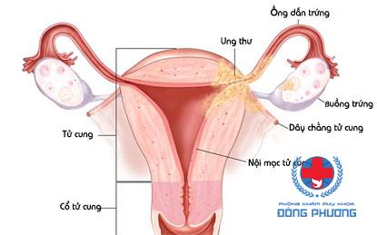Viêm nội mạc tử cung có thể gây ung thư tử cung