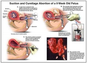 Quy trình hút thai an toàn