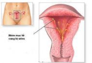 Nguyên nhân viêm nội mạc tử cung