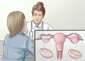 Cách điều trị viêm buồng trứng mãn tính