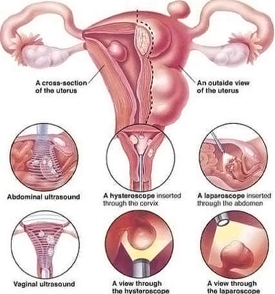 Cách điều trị xơ hóa tử cung