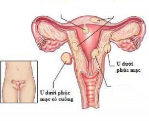 U nang tử cung là gì?