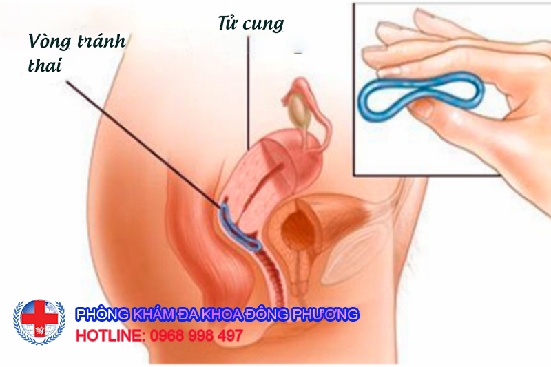 cắt dây vòng tránh thai